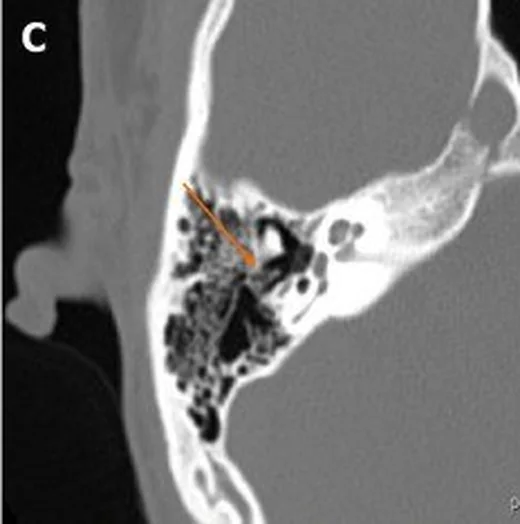Birinci brankiyal yarık kisti ve sinüs: yayımlanmış olgu görüntüsü, sagittal kesit