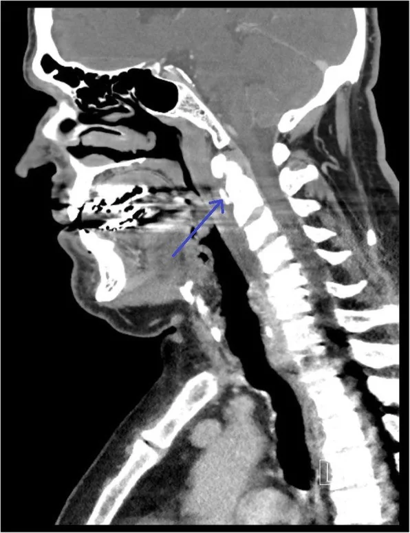 Longus colli kalsifik tendiniti (retrofaringeal apse taklitçisi): yayımlanmış olgu görüntüsü, sagittal kesit