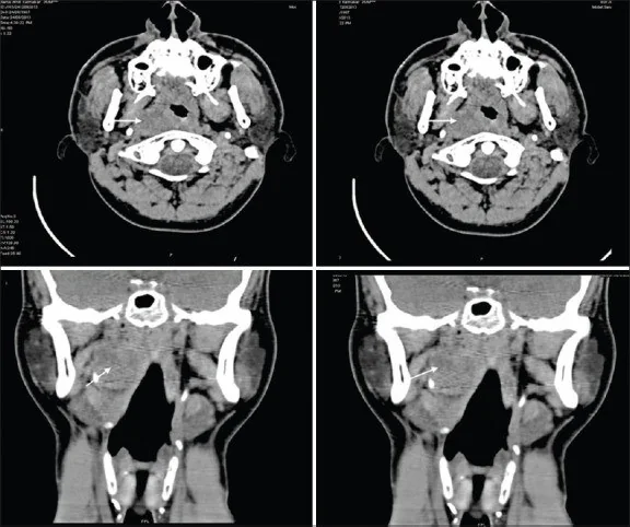 Retrofaringeal lenf nodu metastazı: yayımlanmış olgu görüntüsü, aksiyel kesit