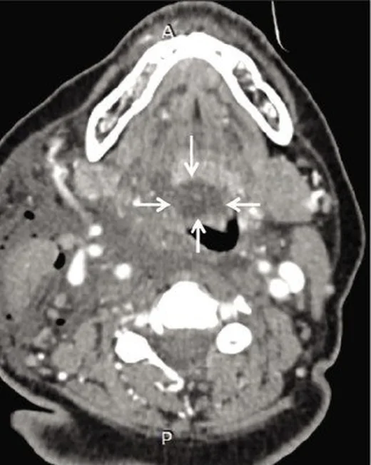 Epiglottik retansiyon kisti: yayımlanmış olgu görüntüsü, aksiyel kesit