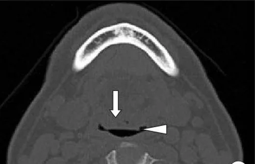 Lingual tonsil hipertrofisi: yayımlanmış olgu görüntüsü, sagittal kesit
