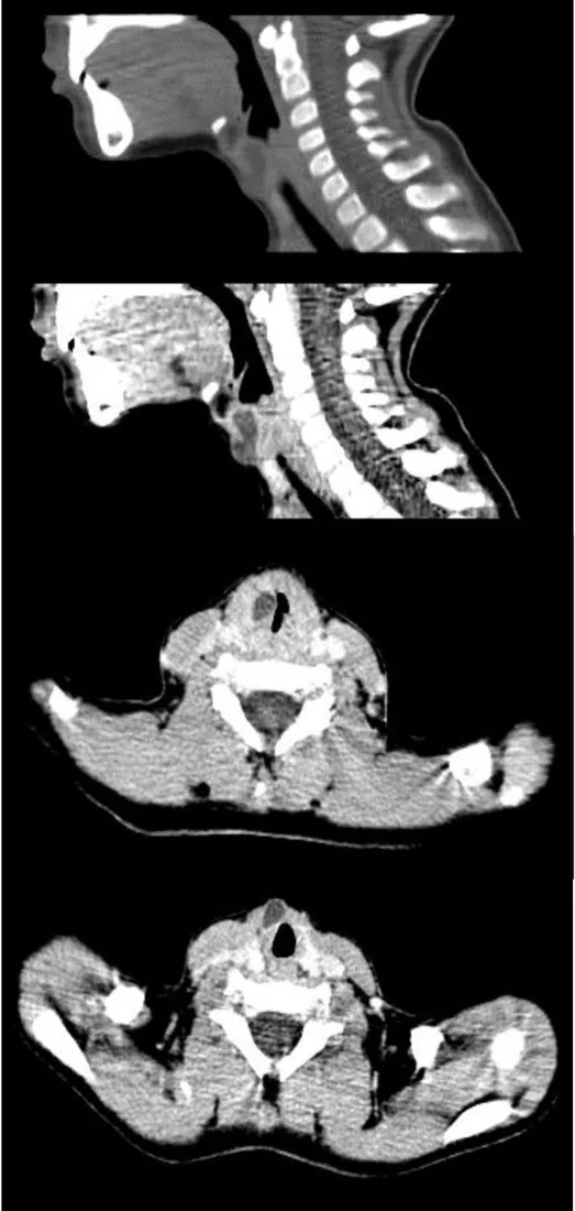 Larengeal sakküler kist: yayımlanmış olgu görüntüsü, sagittal ve aksiyel kesit