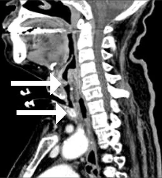 Subglottik stenoz: yayımlanmış olgu görüntüsü, sagittal kesit