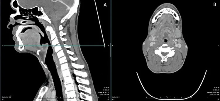 Supraglottik / epiglottik apse: yayımlanmış olgu görüntüsü, aksiyel kesit