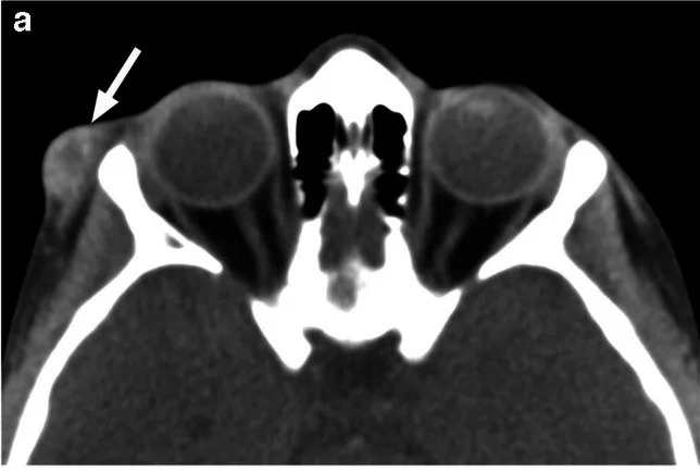 Orbital dermoid / epidermoid kist: yayımlanmış olgu görüntüsü, aksiyel kesit