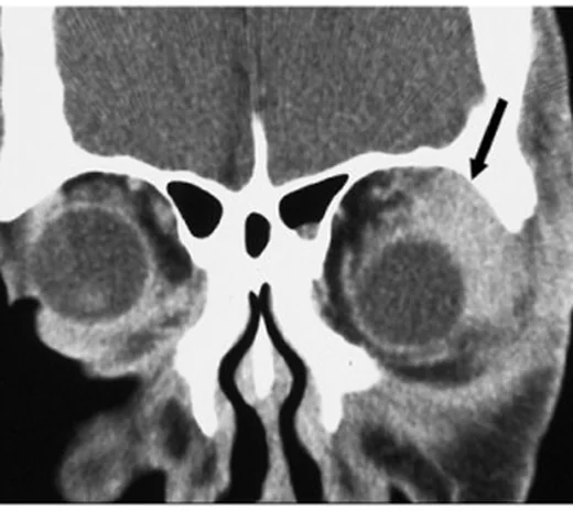 İdiyopatik orbital inflamasyon (orbital psödotümör): yayımlanmış olgu görüntüsü, koronal kesit