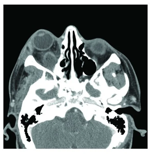 İntraorbital apse: yayımlanmış olgu görüntüsü, aksiyel kesit