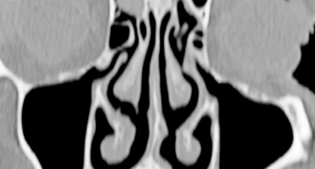 Bölge anatomisi (Paranazal sinüsler), BT kesiti