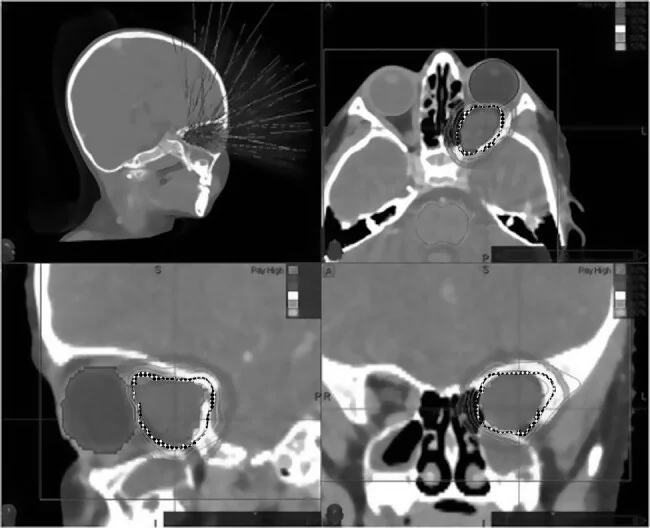 Optik sinir kılıfı menenjiyomu: yayımlanmış olgu görüntüsü, aksiyel+koronal+sagittal kesit