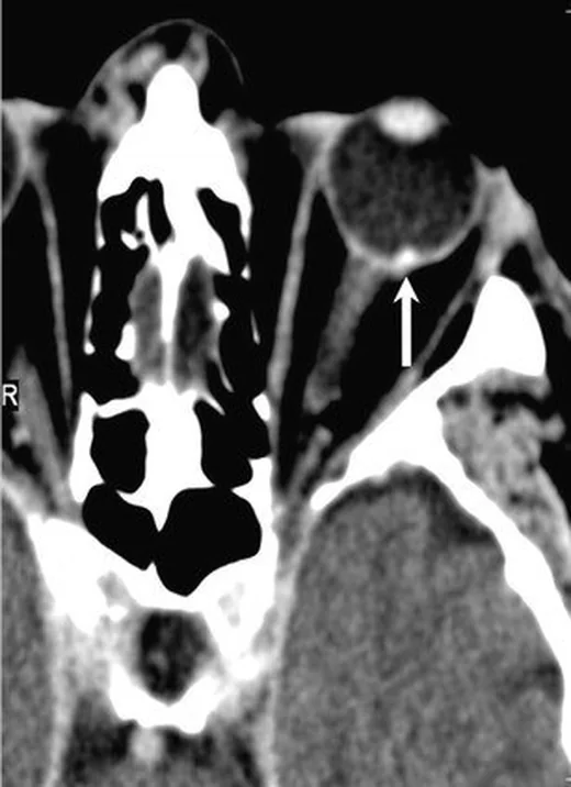 Uveal melanomun orbital BT görünümü: yayımlanmış olgu görüntüsü, aksiyel kesit
