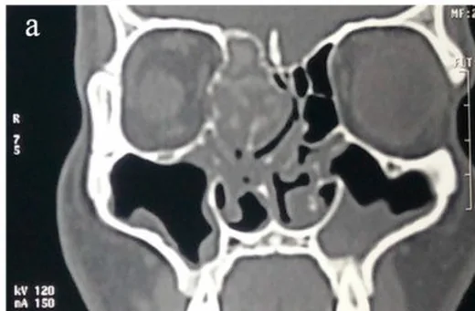 Alerjik fungal rinosinüzit: yayımlanmış olgu görüntüsü, koronal kesit