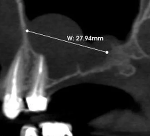 Maksiller sinüs retansiyon kisti: yayımlanmış olgu görüntüsü, sagittal kesit
