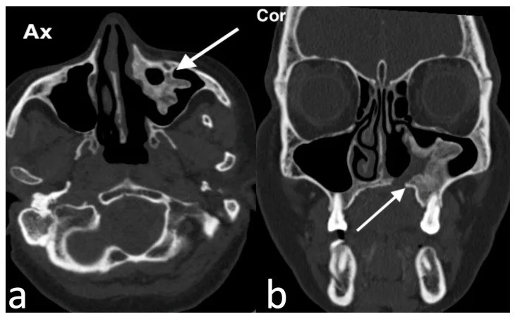 Sinonazal ossifiye fibrom: yayımlanmış olgu görüntüsü, koronal kesit