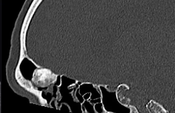 Sinonazal osteom: yayımlanmış olgu görüntüsü, 3B kesit