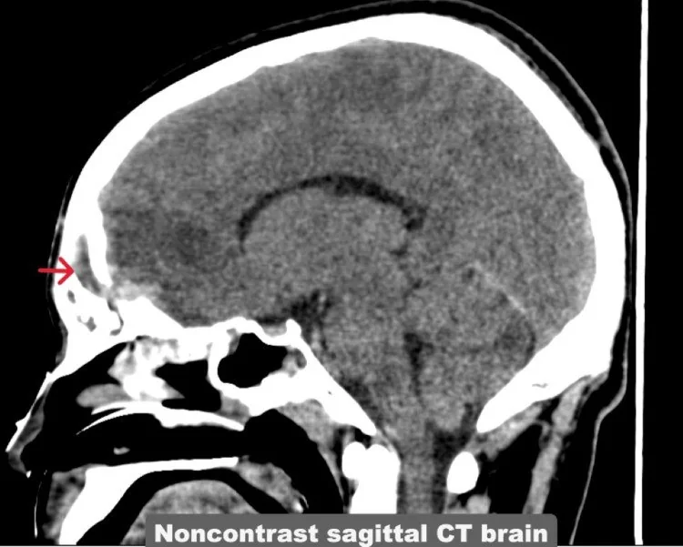 Hematosinüs: yayımlanmış olgu görüntüsü, sagittal kesit