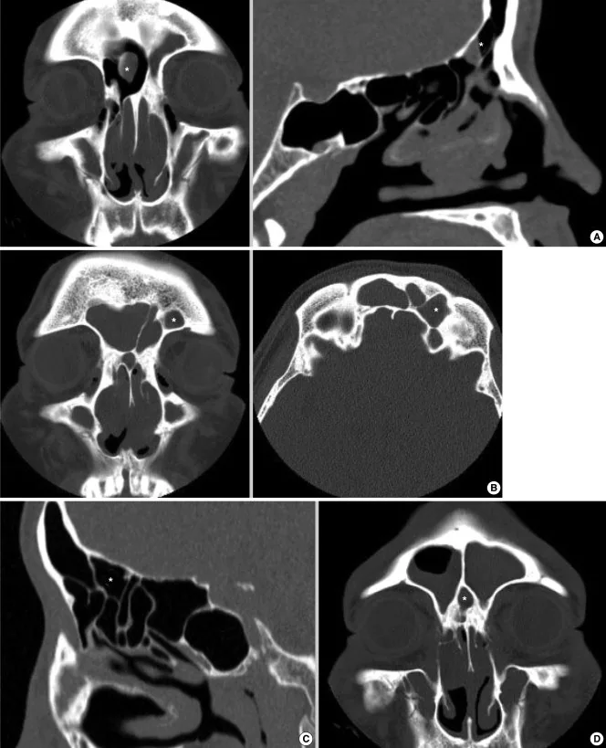 Supraorbital etmoid hücresi: yayımlanmış olgu görüntüsü, aksiyel kesit
