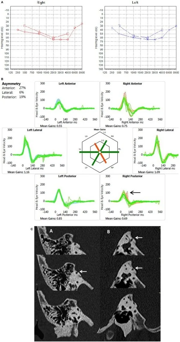 Posterior semisirküler kanal dehisansı: yayımlanmış olgu görüntüsü, koronal+sagittal kesit