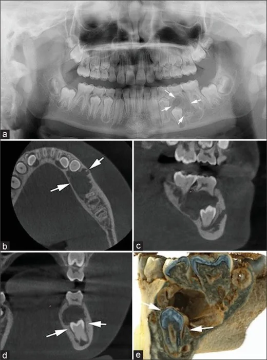 Ameloblastik fibrom: yayımlanmış olgu görüntüsü, aksiyel kesit