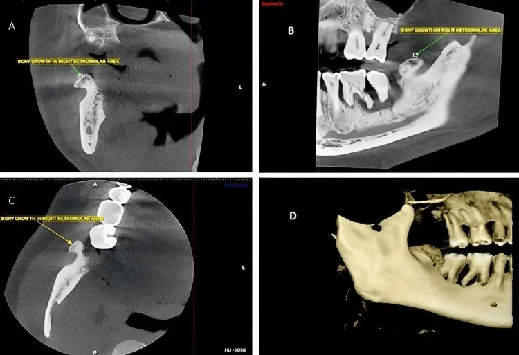 Mandibula veya maksilla osteomu: yayımlanmış olgu görüntüsü, 3B kesit
