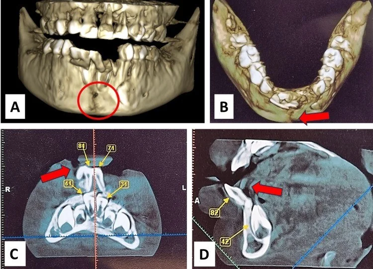 Dentoalveoler kırık: yayımlanmış olgu görüntüsü, 3B kesit
