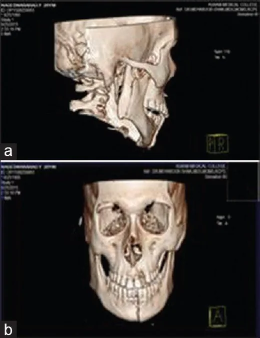Mandibula angulus ve ramus kırığı: yayımlanmış olgu görüntüsü, 3B kesit