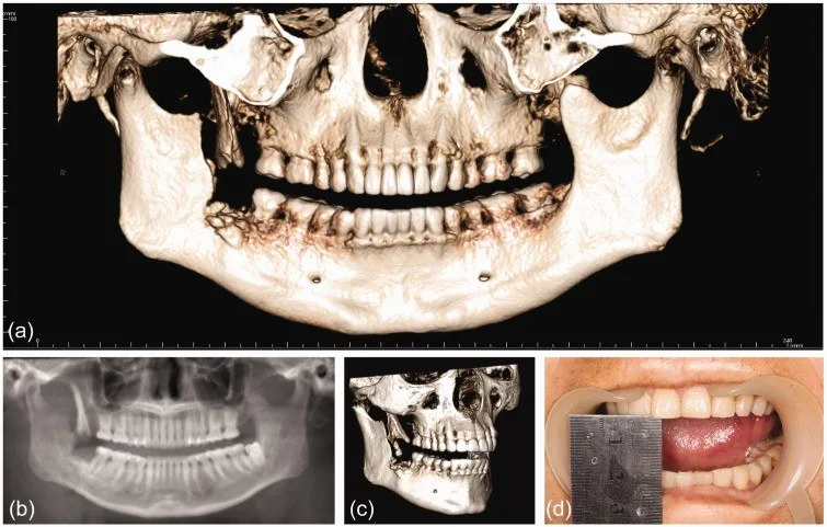 Mandibula koronoid çıkıntı kırığı: yayımlanmış olgu görüntüsü, 3B kesit