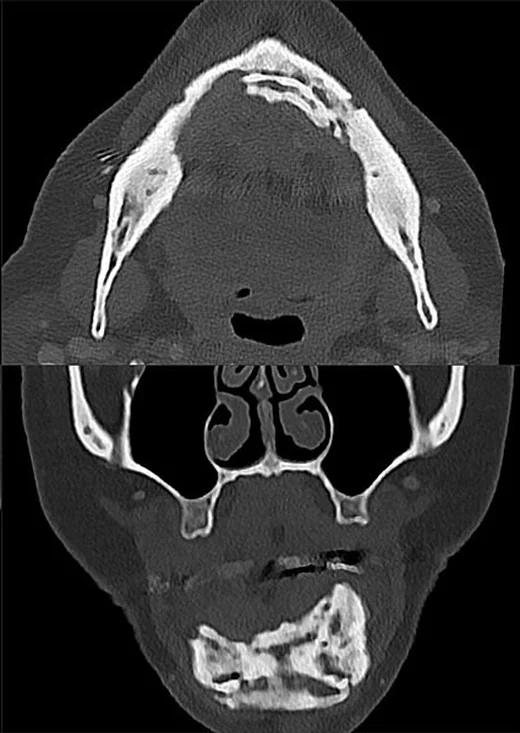 İlaç ilişkili veya radyasyon sonrası mandibula osteonekrozu: yayımlanmış olgu görüntüsü, aksiyel kesit