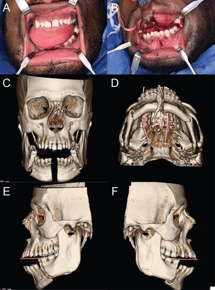 Mandibula simfiz, parasimfiz ve korpus kırığı: yayımlanmış olgu görüntüsü, 3B kesit