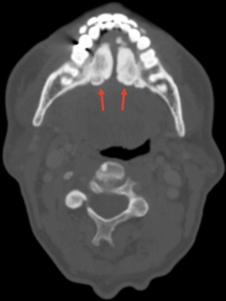 Mandibular torus ve oral ekzostoz: yayımlanmış olgu görüntüsü, aksiyel kesit