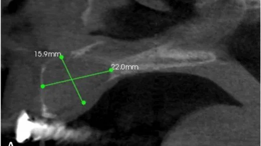 Nasopalatin kanal kisti: yayımlanmış olgu görüntüsü, sagittal kesit