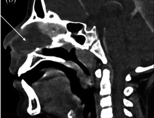 Nazal septum hematomu: yayımlanmış olgu görüntüsü, aksiyel|sagittal kesit