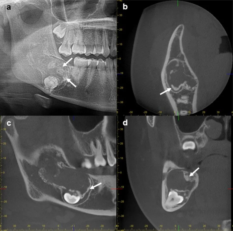Odontojenik fibrom: yayımlanmış olgu görüntüsü, aksiyel|koronal|sagittal kesit