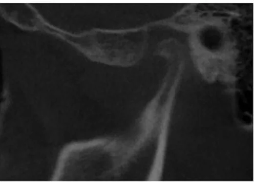 TME dejeneratif osteoartriti: yayımlanmış olgu görüntüsü, sagittal kesit