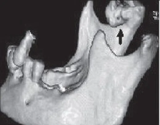 Mandibular kondil osteokondromu: yayımlanmış olgu görüntüsü, 3B kesit