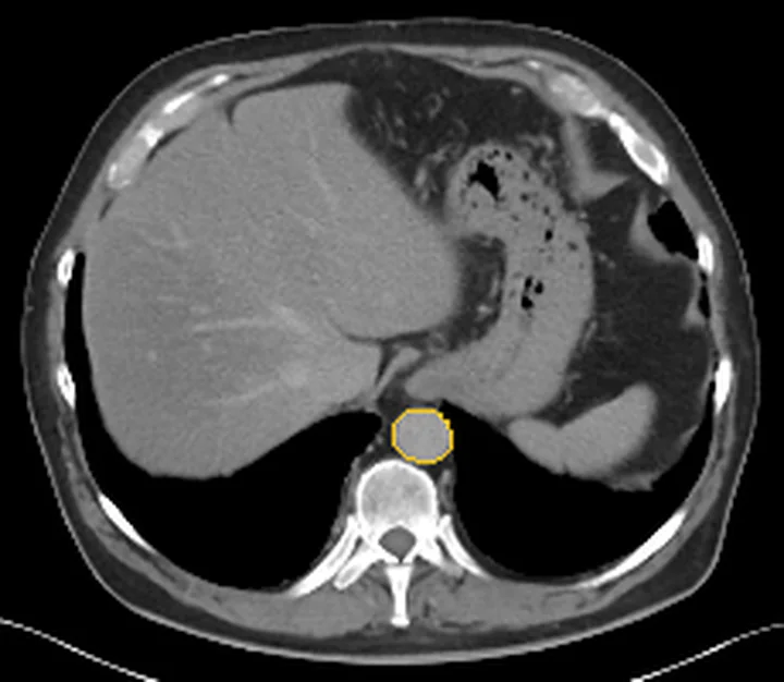 Bölge anatomisi, BT kesiti: Aorta sınırı sarı çizgiyle işaretli