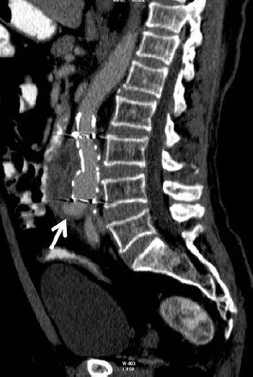 Endoleak: endovasküler aort onarımı sonrası kese içi kaçak: yayımlanmış olgu görüntüsü, sagittal kesit