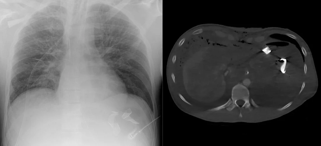 Hemostatik materyal ve amaçlı cerrahi packing taklitçileri: yayımlanmış olgu görüntüsü, aksiyel kesit