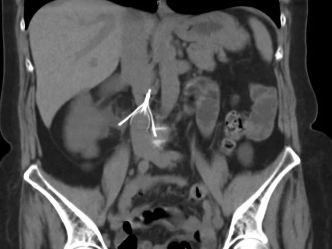 İnferior vena kava filtresi: tilt, penetrasyon, tromboz ve migrasyon: yayımlanmış olgu görüntüsü, koronal kesit