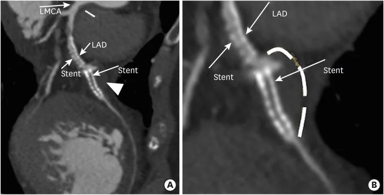 Koroner stent kırığı, trombozu ve restenozunun BT görünümü: yayımlanmış olgu görüntüsü, sagittal kesit