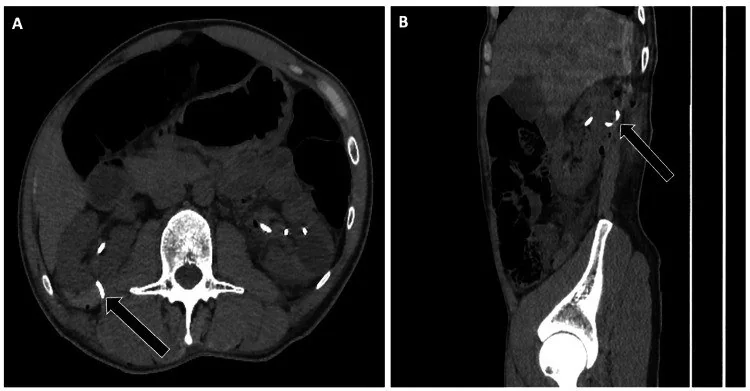 Nefrostomi ve üreteral stent komplikasyonları: yayımlanmış olgu görüntüsü, aksiyel kesit