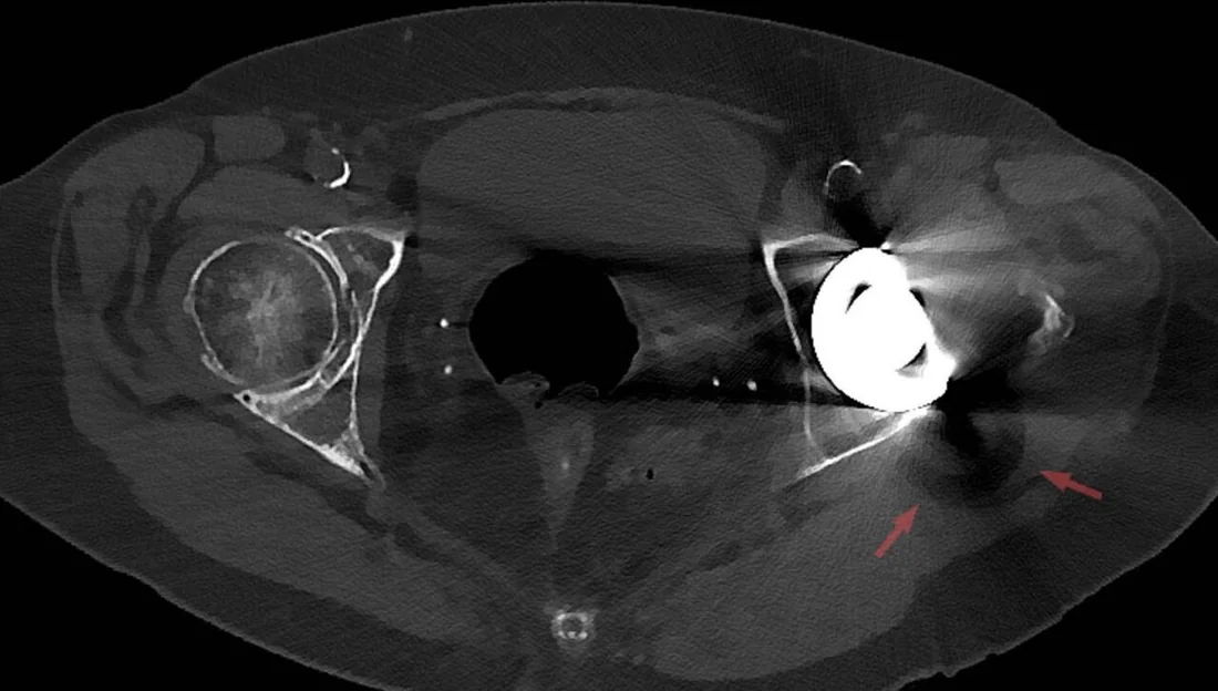Ortopedik protez ve osteosentez materyali komplikasyonları: yayımlanmış olgu görüntüsü, aksiyel kesit