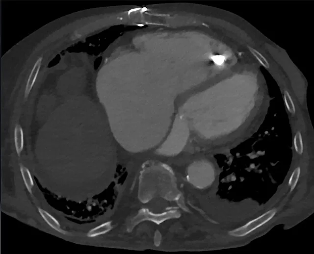 Pacemaker, ICD ve kardiyak cihazların normal konfigürasyonları: yayımlanmış olgu görüntüsü, koronal kesit