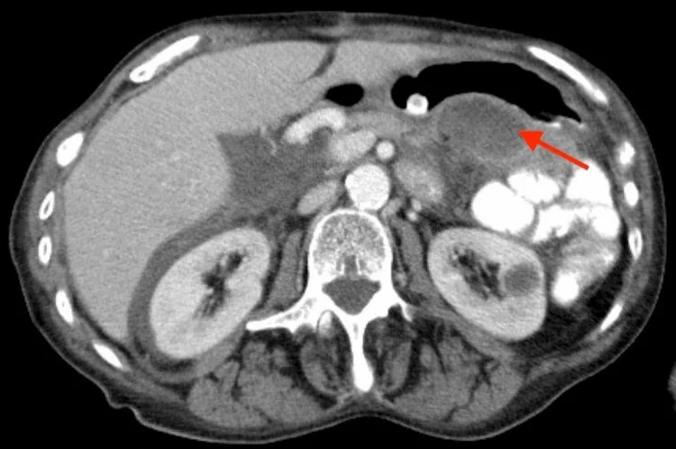 Postoperatif apse, enfekte koleksiyon ve fistül: yayımlanmış olgu görüntüsü, aksiyel kesit