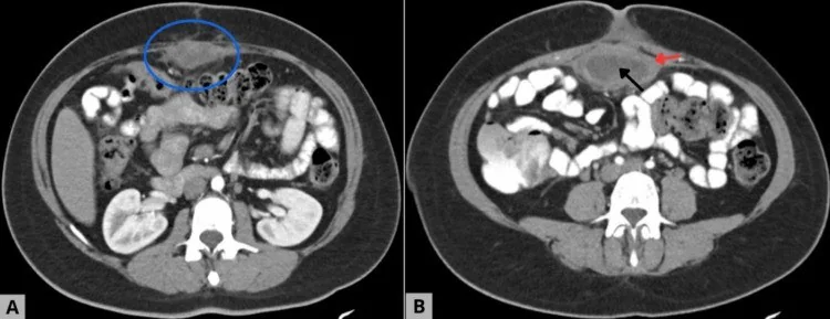 Retansiyone cerrahi materyal: gossypiboma/textiloma ve unutulmuş yabancı cisim: yayımlanmış olgu görüntüsü, aksiyel kesit