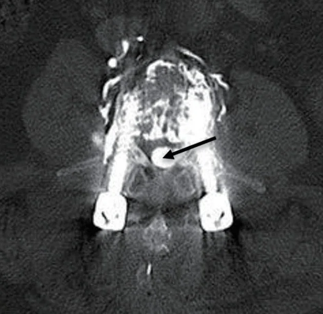 Spinal enstrümantasyon, vida ve kemik çimentosu komplikasyonları: yayımlanmış olgu görüntüsü, aksiyel kesit
