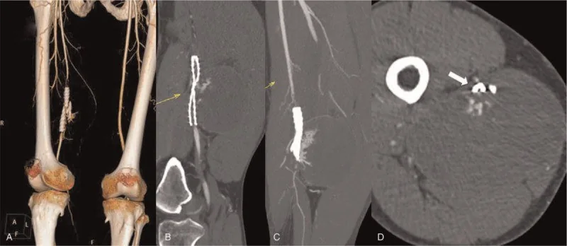 Vasküler stent/greft oklüzyonu, tromboz ve restenoz: yayımlanmış olgu görüntüsü, 3B kesit
