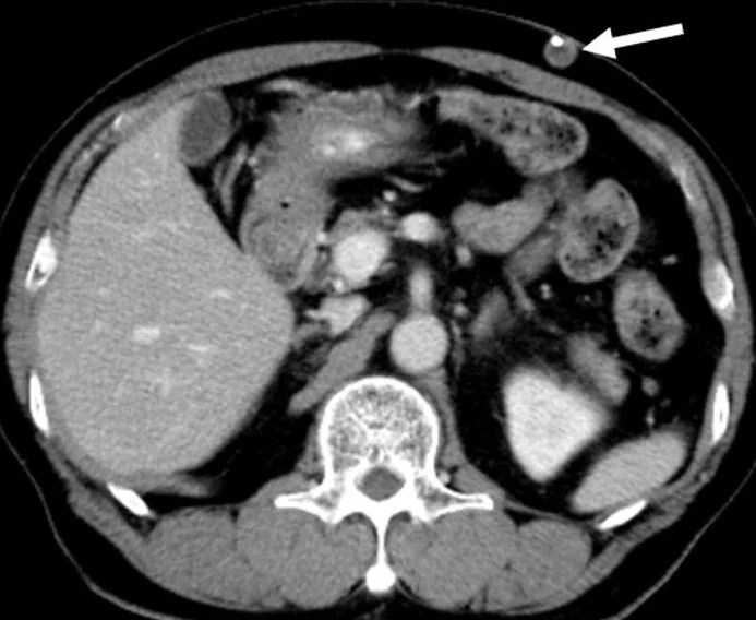 Ventriküloperitoneal şant: distal kateter migrasyonu ve abdominal komplikasyon: yayımlanmış olgu görüntüsü, aksiyel kesit