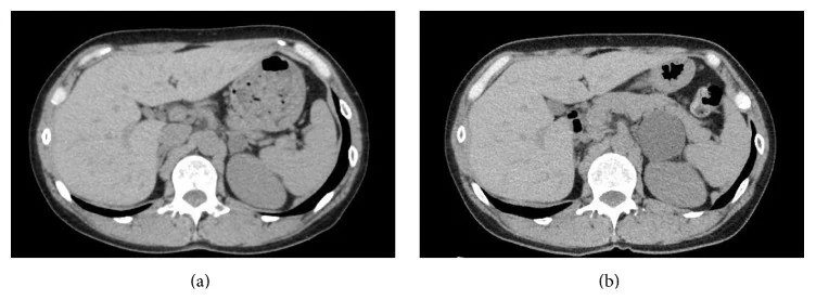 Adrenal kist ve psödokist: yayımlanmış olgu görüntüsü, aksiyel kesit