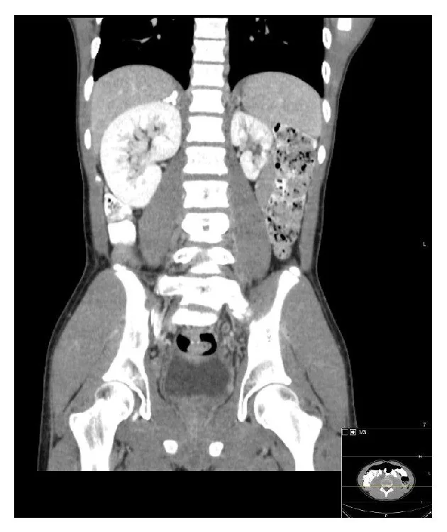 Adrenal hemanjiyom ve kalsifiye adrenal kitle: yayımlanmış olgu görüntüsü, koronal kesit