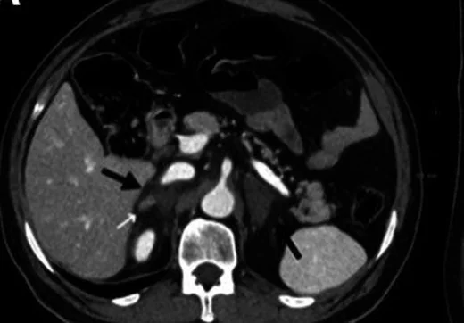 Adrenal hemoraji: yayımlanmış olgu görüntüsü, aksiyel kesit